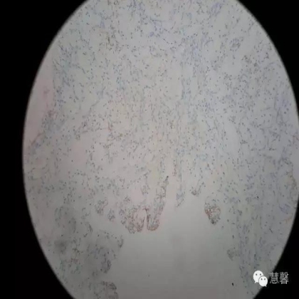 透明细胞乳头状肾细胞癌？TFE3 Traslocation Carcinoma？（赵洋分享，孔祥田(Max)*NM老师讲解）