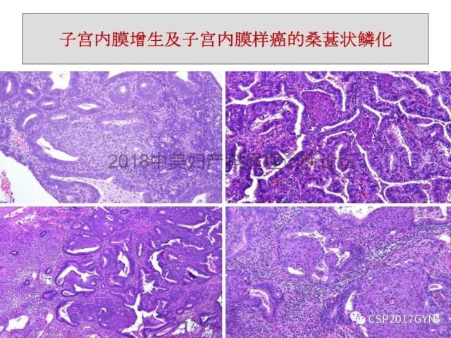 子宫内膜假肿瘤性病变及类似癌样病变