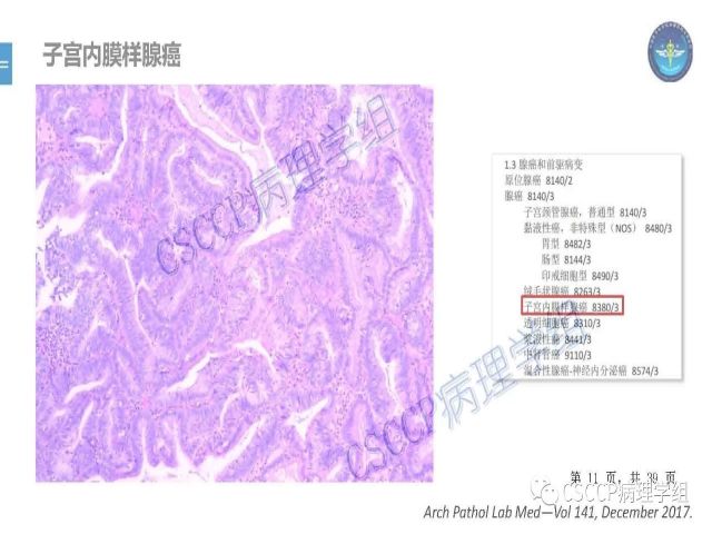 黄文亭 张询：宫颈腺癌分类介绍