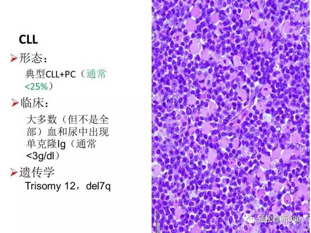 浆细胞相关肿瘤的病理诊断及鉴别诊断