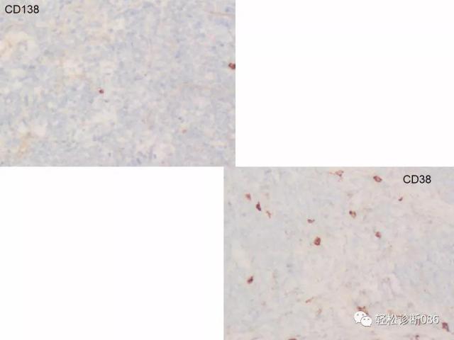 BPDCN病例分享