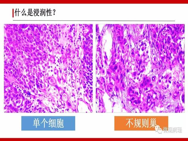 泌尿课程/浸润性尿路上皮癌病理学类型