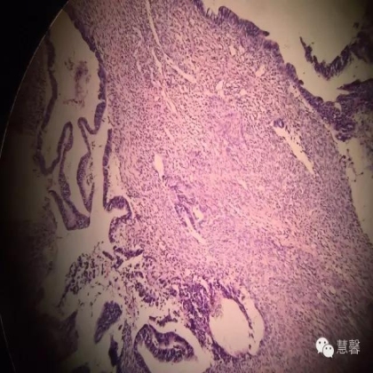 交界性黏液性囊腺瘤？癌？（魏娉分享，刘从容老师讲解）