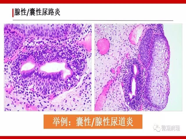 泌尿课程/尿路腺样病变的诊断要点