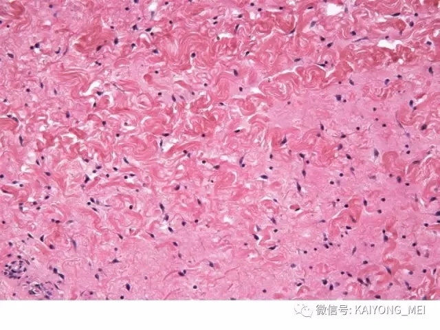 女性生殖道软组织肿瘤病理诊断及进展（一）