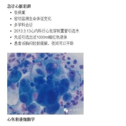 中日韩个体化诊疗案例大赛经典赏析之十三——组织活检突变阴性，血液检测EGFR19DEL,TKI 治疗PFS9个月