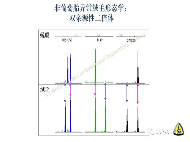 p57免疫组化染色及基因分型 在葡萄胎精确诊断中的应用
