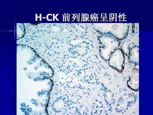 前列腺病理诊断线索（上）——黄教悌