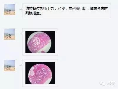 关于前列腺增生及PIN相关问题（张睿病例分享，孔祥田(Max)*Roswell*NM]老师讲解）