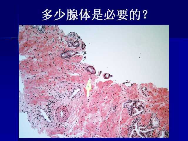 前列腺病理诊断线索（下）——黄教悌