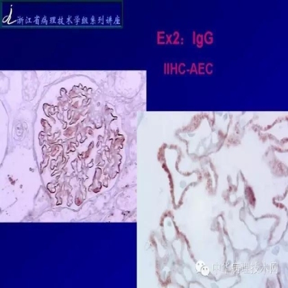 探讨免疫组织学在肾穿标本中的应用