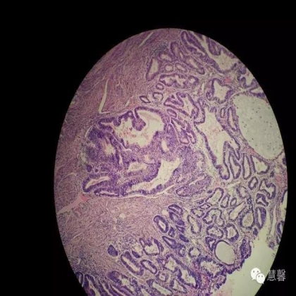 子宫内膜癌、宫内膜增殖症的鳞状分化、桑葚化生等问题（石岩分享，刘从容老师讲解）