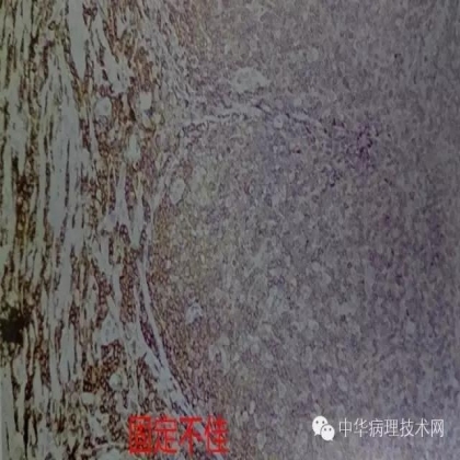 免疫组化结果的分析和常见问题的处理