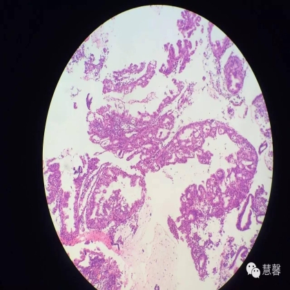 子宫内膜乳头状增生（甜甜分享病例，孔祥田(Max)*Roswell*老师讲解，kent翻译整理文献）