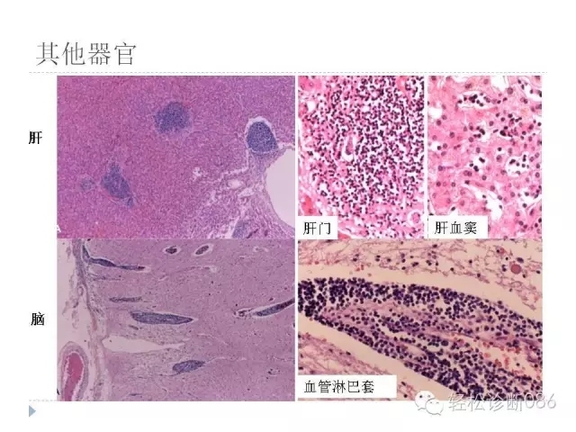 慢性淋巴细胞性白血病