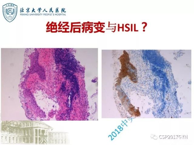 宫颈鳞状上皮内病变病理诊断中问题