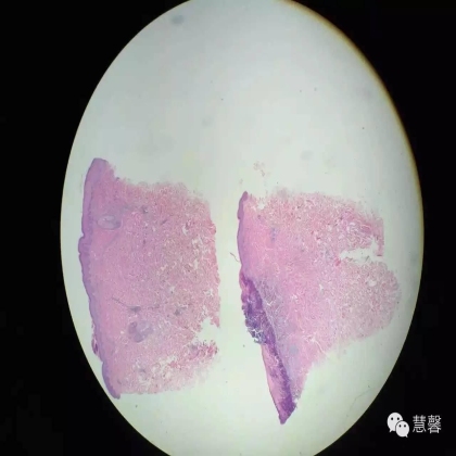Acquired perforating dermatosis（孔祥田(Max)*Roswell*NM]分享及讲解）