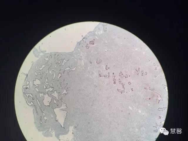 关于前列腺增生及PIN相关问题（张睿病例分享，孔祥田(Max)*Roswell*NM]老师讲解）