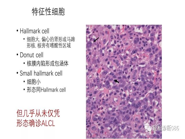 间变大细胞淋巴瘤