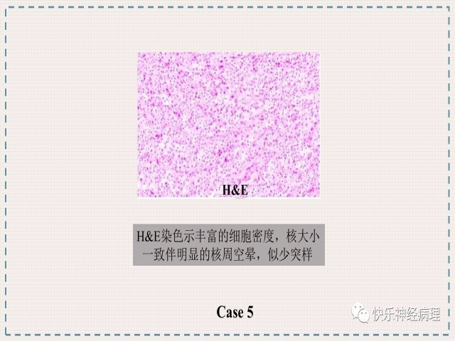 胶质瘤分子结果矛盾时如何整合诊断