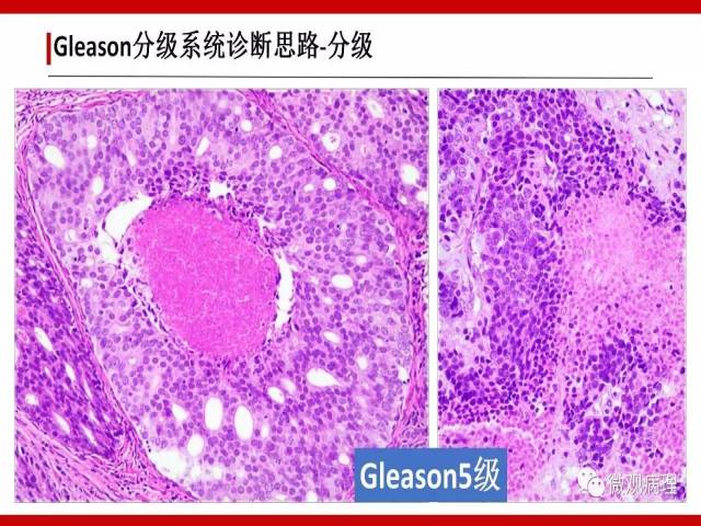 前列腺癌Gleason分级系统的前世今生