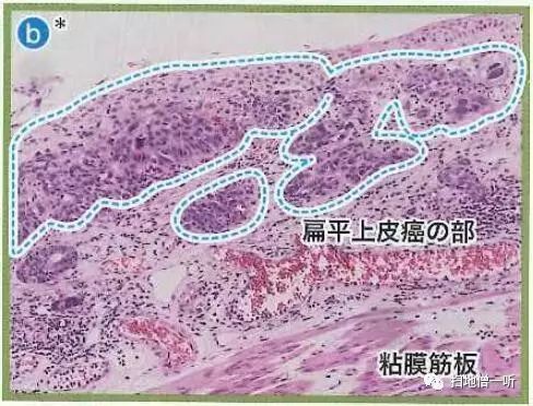 病理解读：神经内分泌癌伴扁平上皮癌