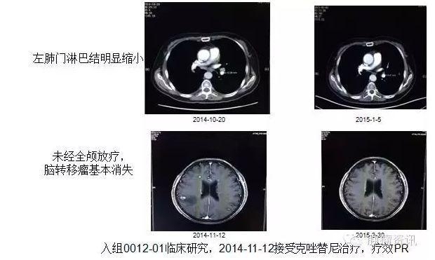 中日韩个体化诊疗案例大赛经典赏析之十——EGFR敏感突变患者，如果TKI原发性耐药，需警惕合并其他驱动基因变异！