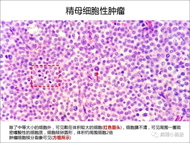 泌尿病理--精原细胞瘤VS精母细胞瘤