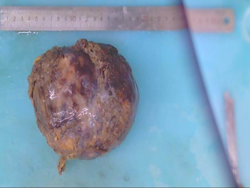 腹膜后脂肪肉瘤