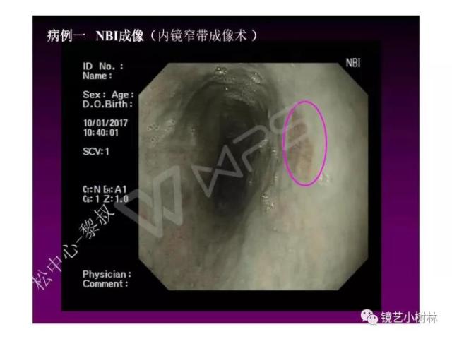 上消化道早癌病理的学习心得体会（附胃牵手癌的病例特点文献学习）