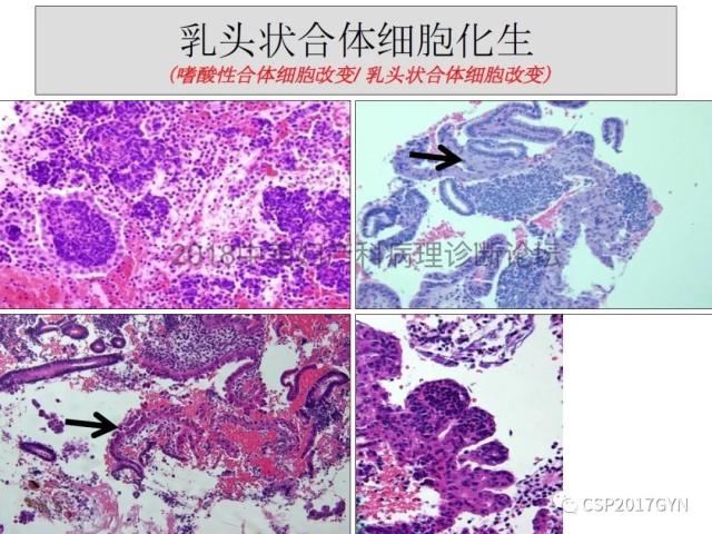 子宫内膜假肿瘤性病变及类似癌样病变