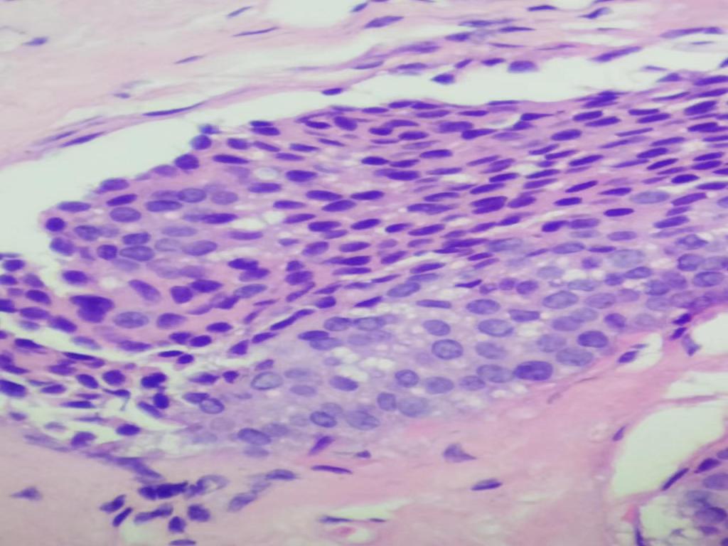 组织学1级的乳腺浸润性导管癌（札记七十五）