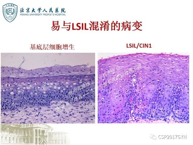 中华病理学会基层培训遵义站讲座（三）——宫颈鳞状上皮病变的病理诊断与鉴别诊断