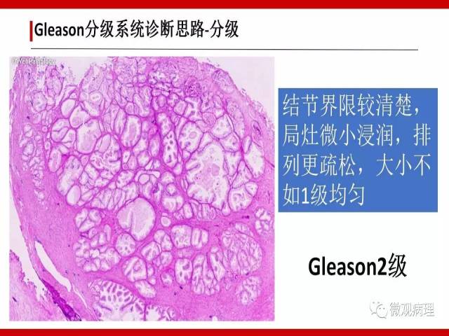 前列腺癌Gleason分级系统的前世今生