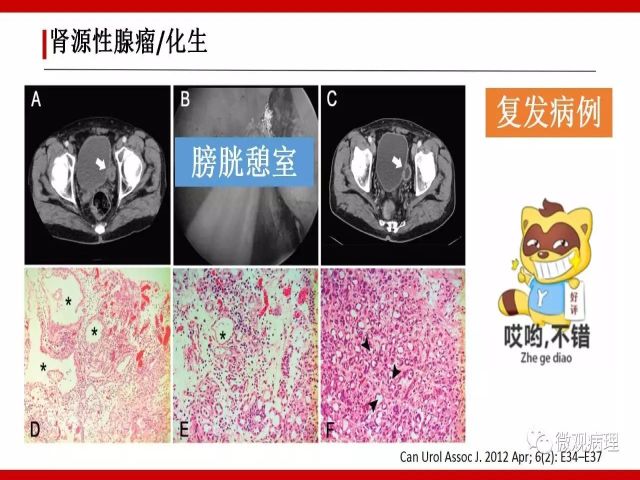 泌尿课程/尿路腺样病变的诊断要点