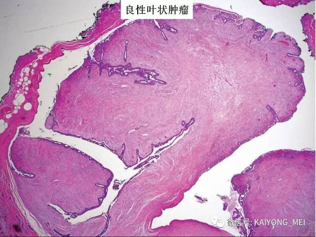 乳腺梭形细胞病变的病理诊断及进展（二）