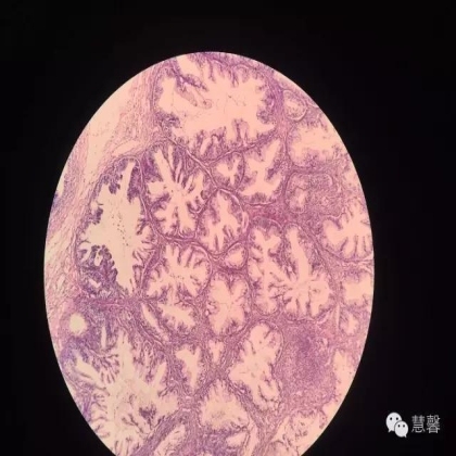 交界性黏液性囊腺瘤？癌？（魏娉分享，刘从容老师讲解）