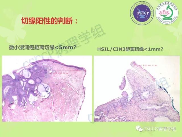 宫颈与子宫病变病理标本取材