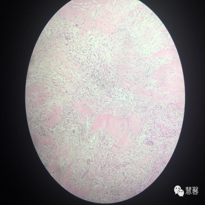 乳腺叶状肿瘤诊断（慧馨分享，孔祥田(Max)*Roswell*NM老师讲解）