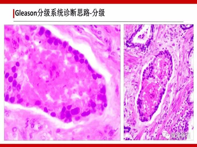前列腺癌Gleason分级系统的前世今生