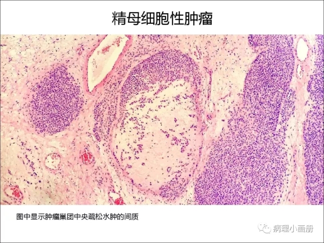 泌尿病理--精原细胞瘤VS精母细胞瘤