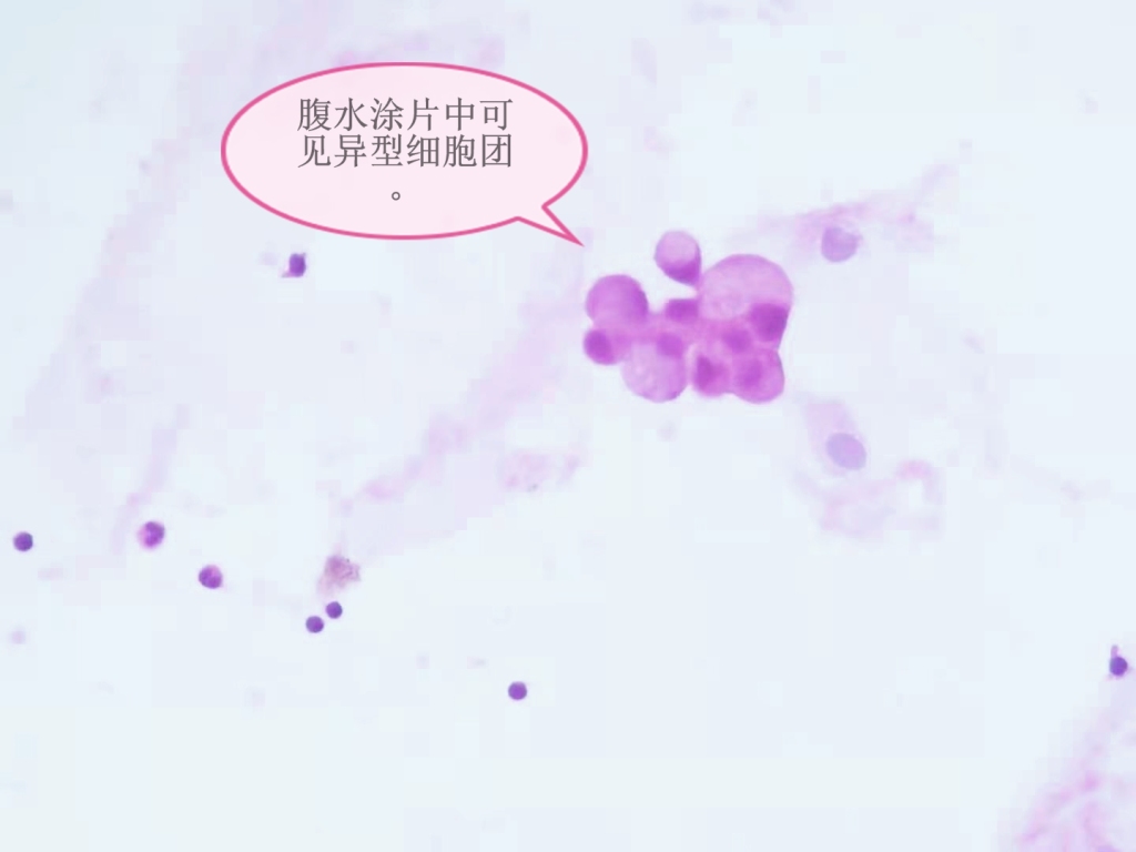 腹水转移癌，未找到原发灶——病理科工作札记（五十六）