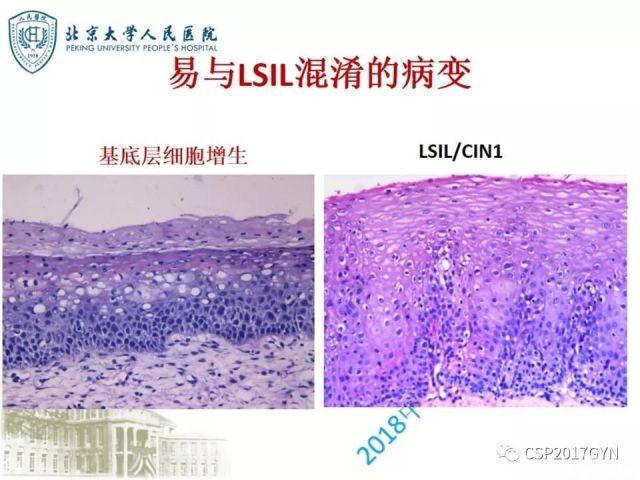 宫颈鳞状上皮内病变病理诊断中问题
