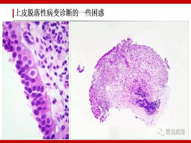 膀胱尿路上皮肿瘤诊断的一些困惑