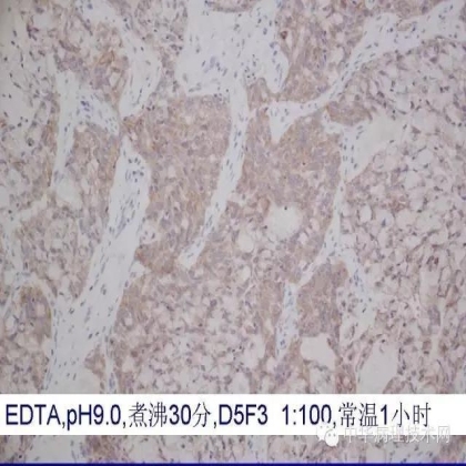 《常规免疫组化初筛ALK阳性非小细胞肺癌专家共识》技术部分解读