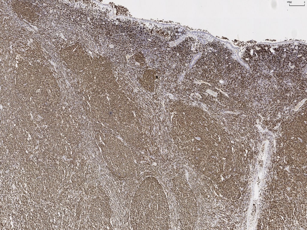 盲肠淋巴瘤