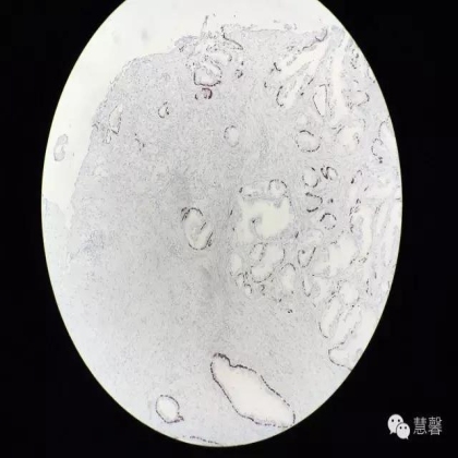 前列腺腺癌？（芳分享病例，华夏泌尿群讨论，孔祥田老师讲解）