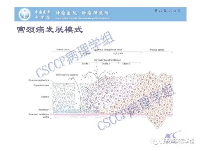 宫颈癌前病变中的诊断难点及阴道镜中ECC的 应用价值