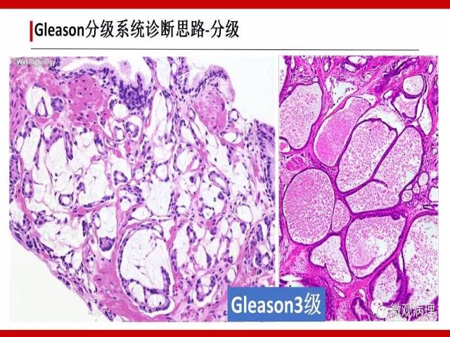 前列腺癌Gleason分级系统的前世今生
