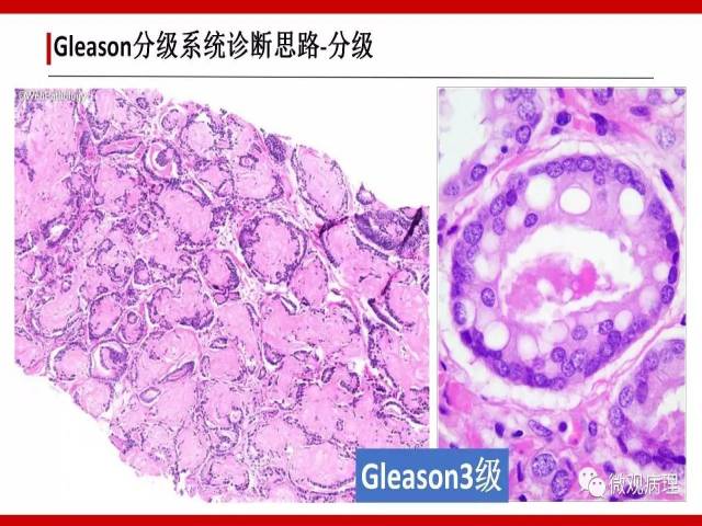前列腺癌Gleason分级系统的前世今生